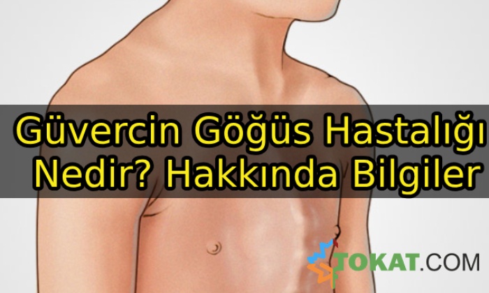 Güvercin Göğüs Hastalığı Nedir? Hakkında Bilgiler