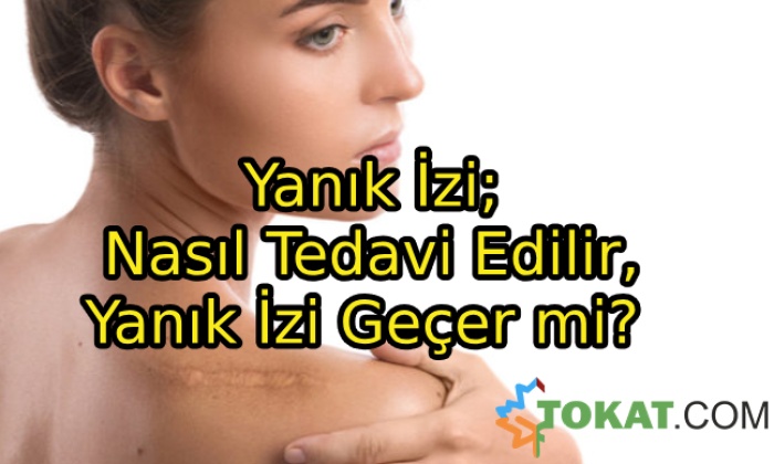 Yanık İzi; Nasıl Tedavi Edilir, Yanık İzi Geçer mi?